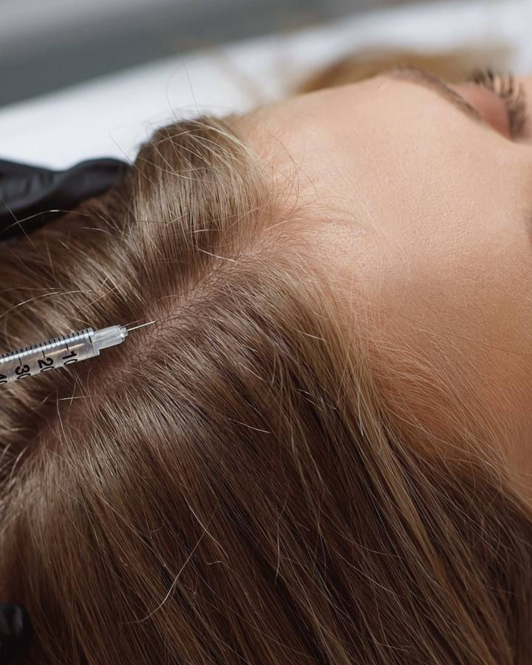 Mesoterapia capilar: precio por sesión, cuántas se necesitan y para qué tipo de caída funciona