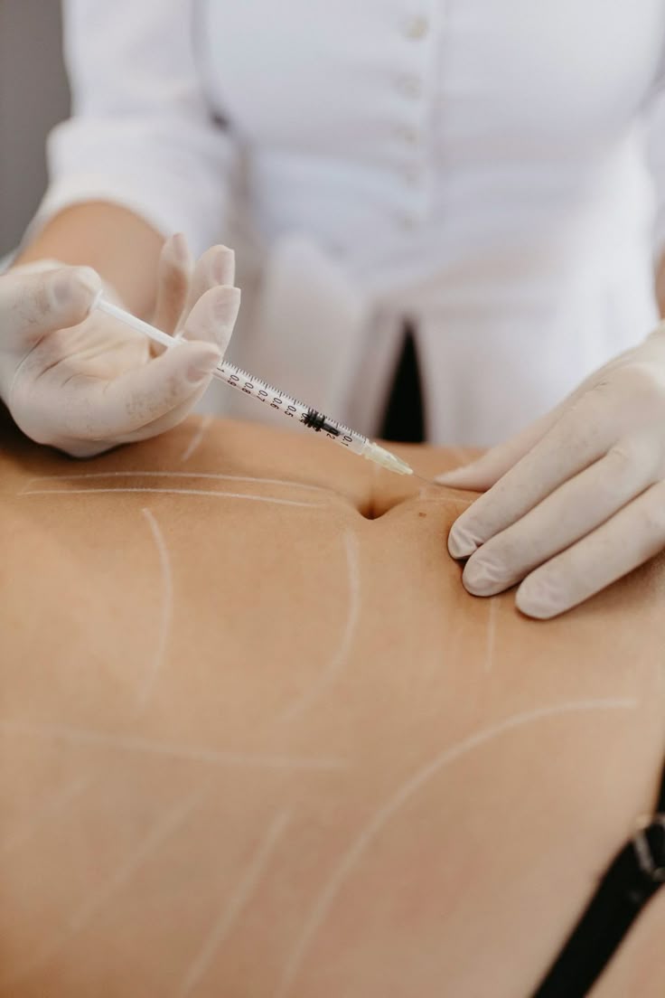 Mesoterapia Reductiva + Masaje: protocolo Beldon para grasa localizada y celulitis.