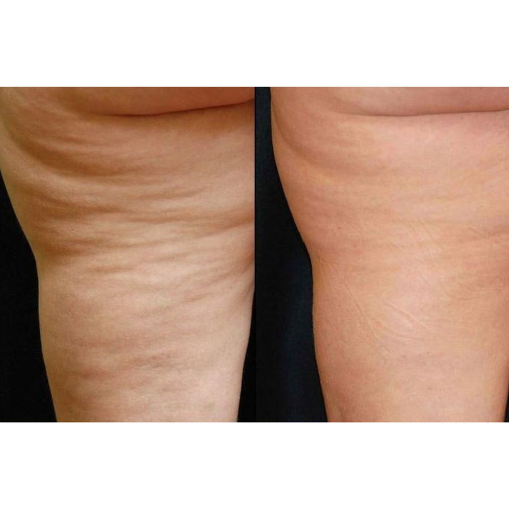 ReshapeX Body - Alma Primex