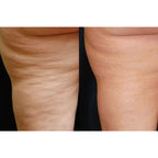 ReshapeX Body - Alma Primex
