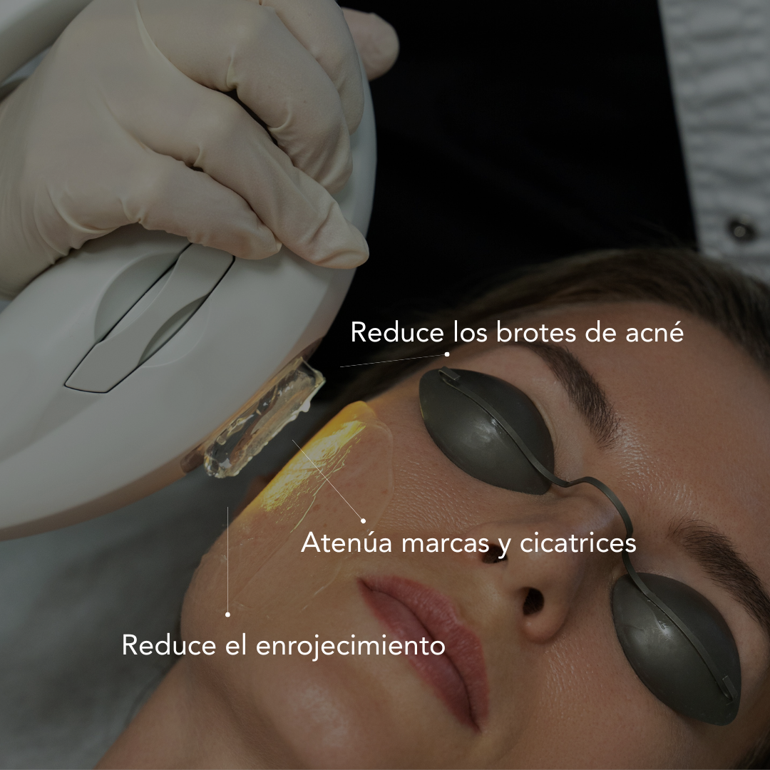 Tratamiento Anti Imperfecciones con IPL