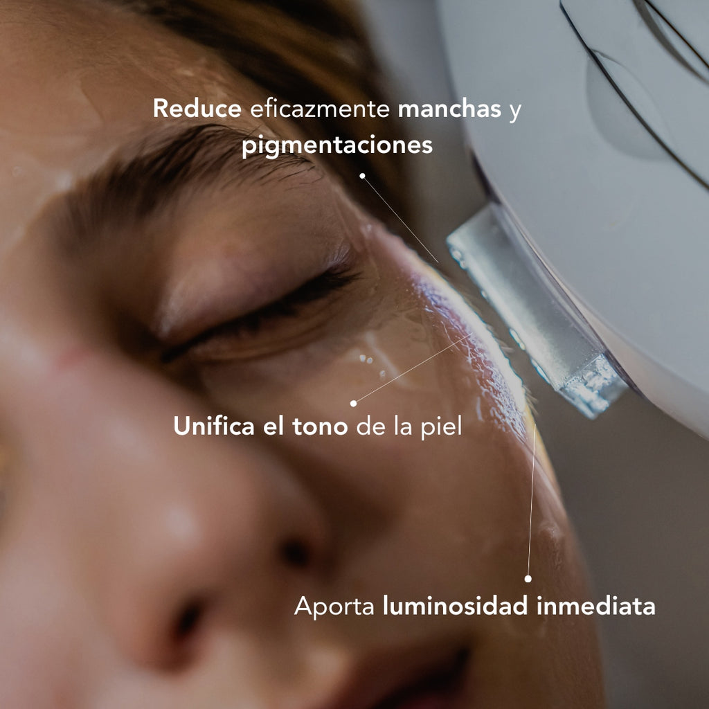 Tratamiento Anti Manchas con IPL