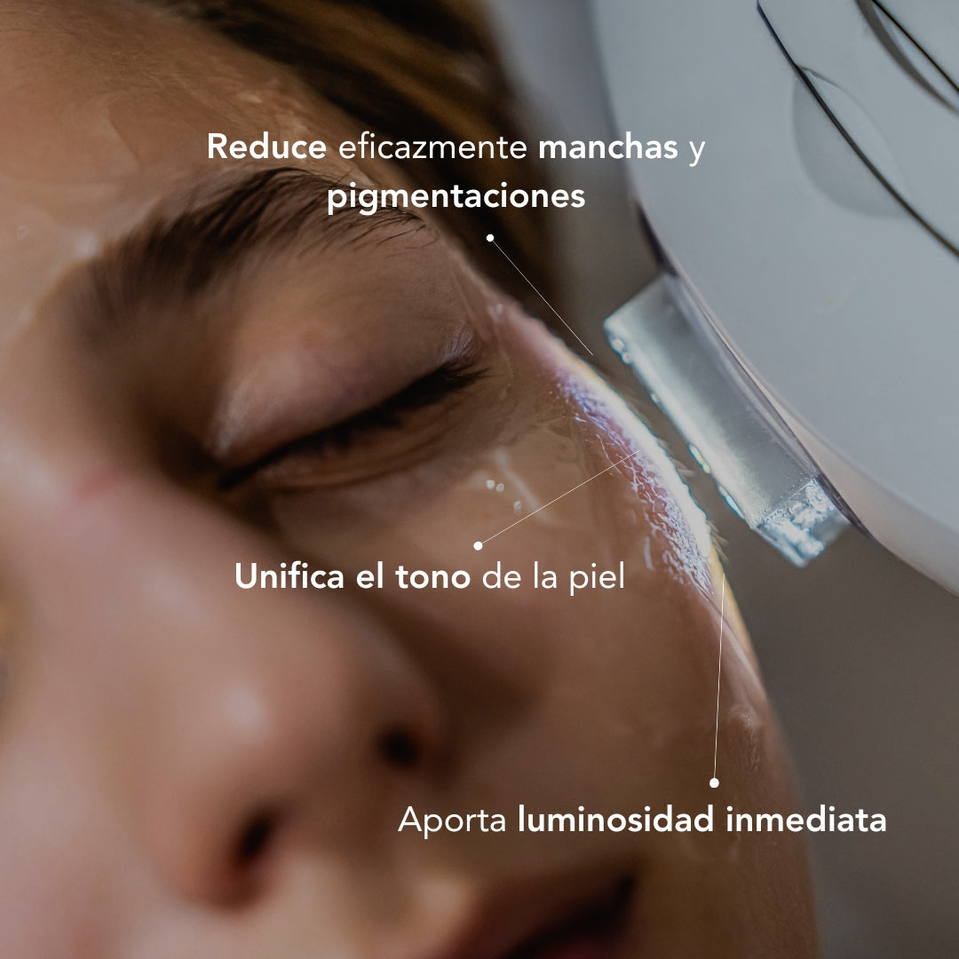 Tratamiento Anti Manchas con IPL