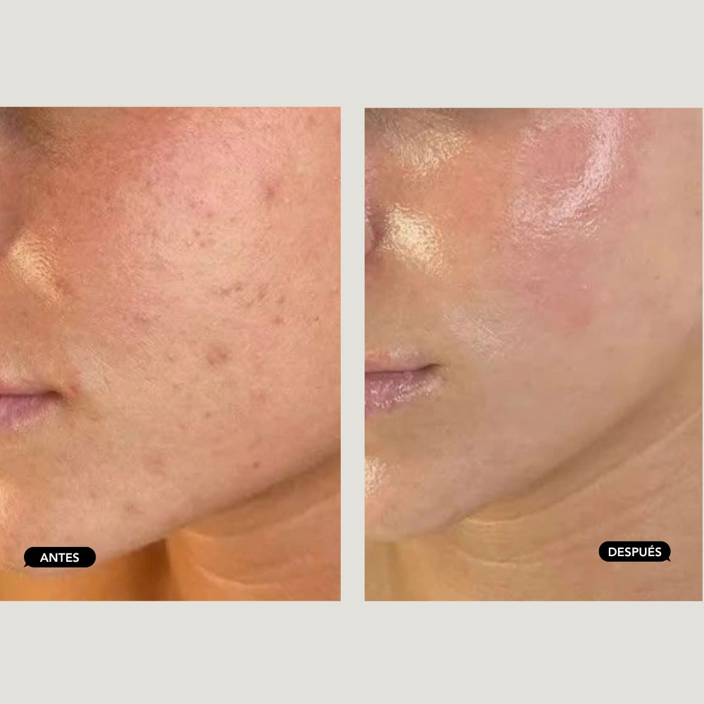 Tratamiento Anti Manchas con IPL