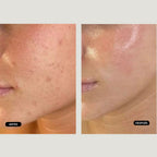 Tratamiento Anti Manchas con IPL