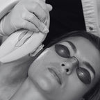 Tratamiento Anti Manchas con IPL