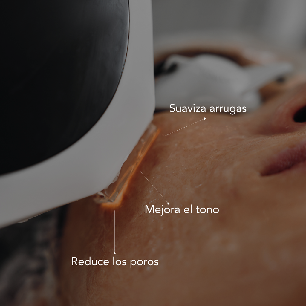 Tratamiento de Rejuvenecimiento con IPL