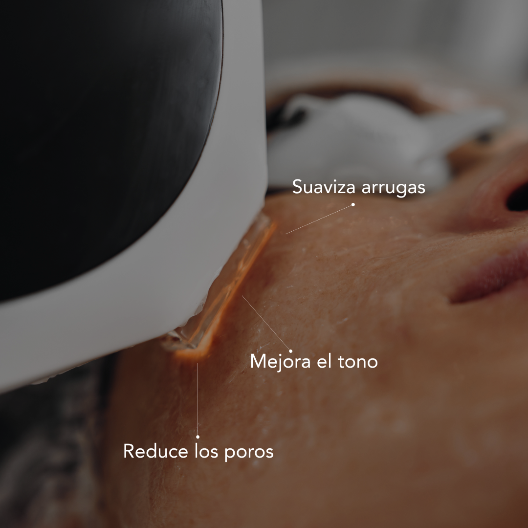 Tratamiento de Rejuvenecimiento con IPL