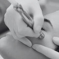 Microdermabrasion