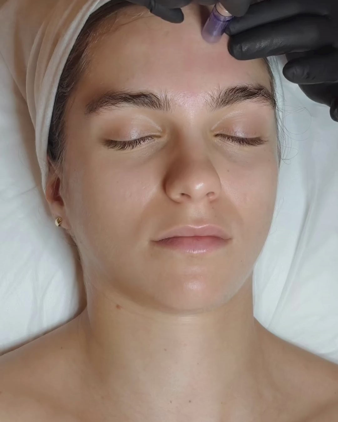 Tratamiento Facial Exosomas