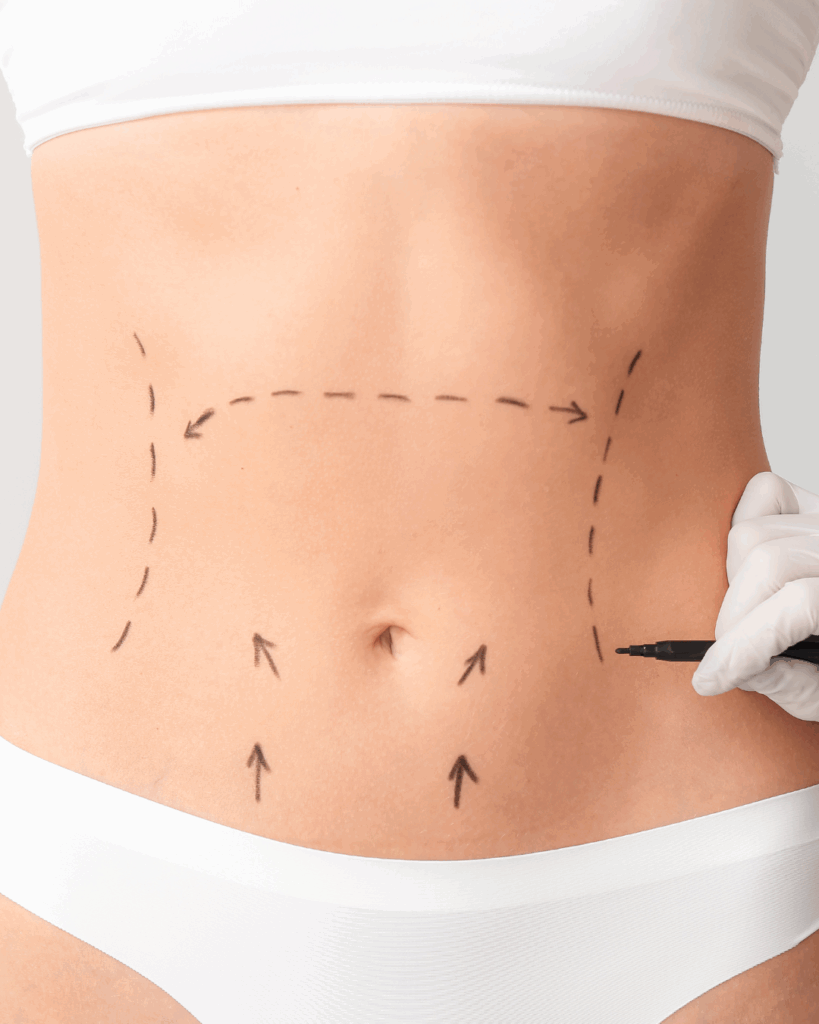 tratamiento flacidez cuerpo pre