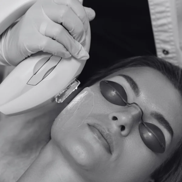 ipl tratamiento anti manchas