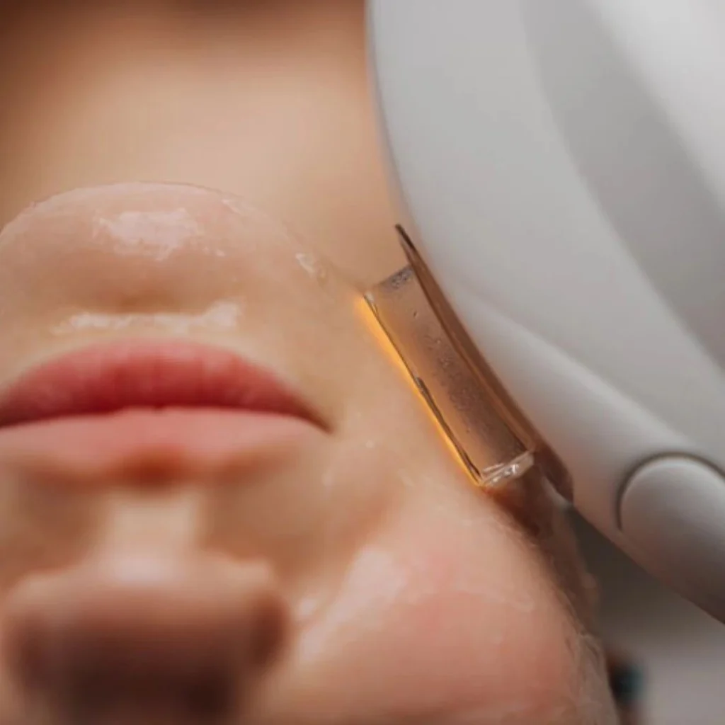 IPL Luz Pulsada Madrid Rejuvenecimiento facial