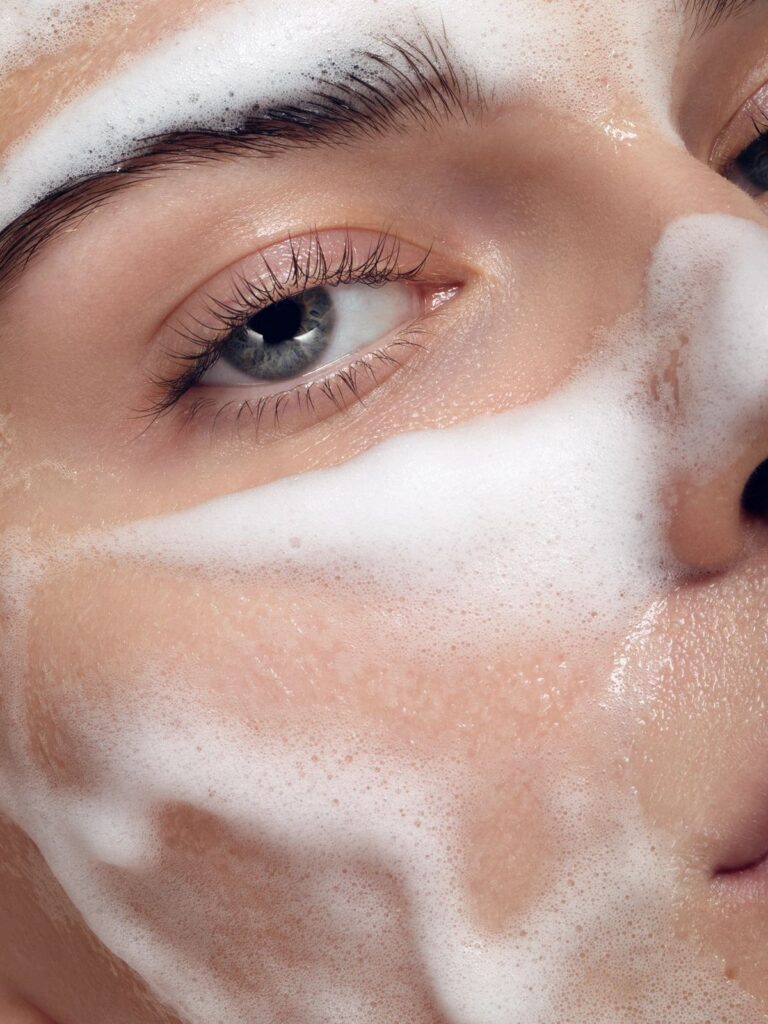 Rostro femenino con enrojecimiento característico de la rosácea, mostrando una piel más calmada tras tratamiento especializado.