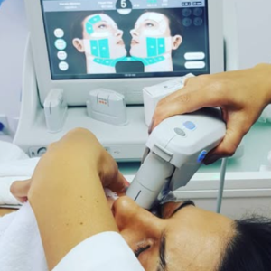 facial ultherapy zona periocular