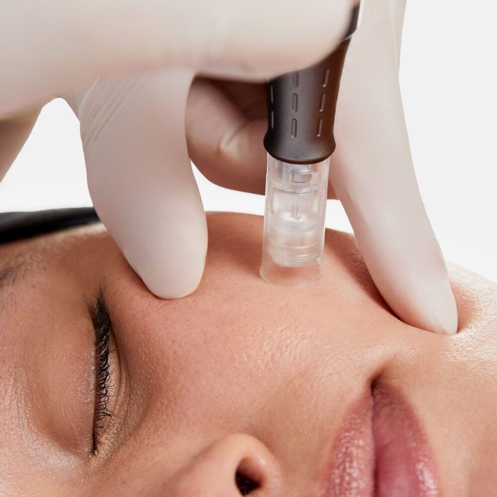 Tratamiento facial con Dermapen y mesoterapia para favorecer la absorción de vitaminas y estimular colágeno.