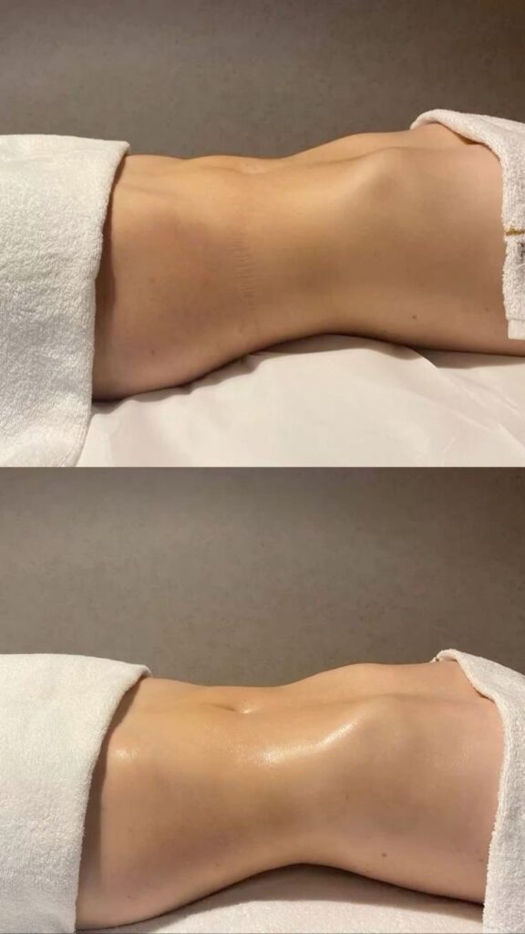 Presoterapia profesional integrada en un circuito corporal avanzado para potenciar el drenaje y la sensación de ligereza.