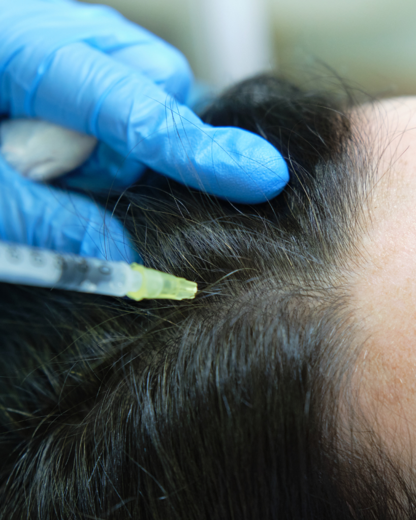Aplicación de tratamiento capilar con plasma en el cuero cabelludo, mostrando mayor densidad y grosor del cabello.