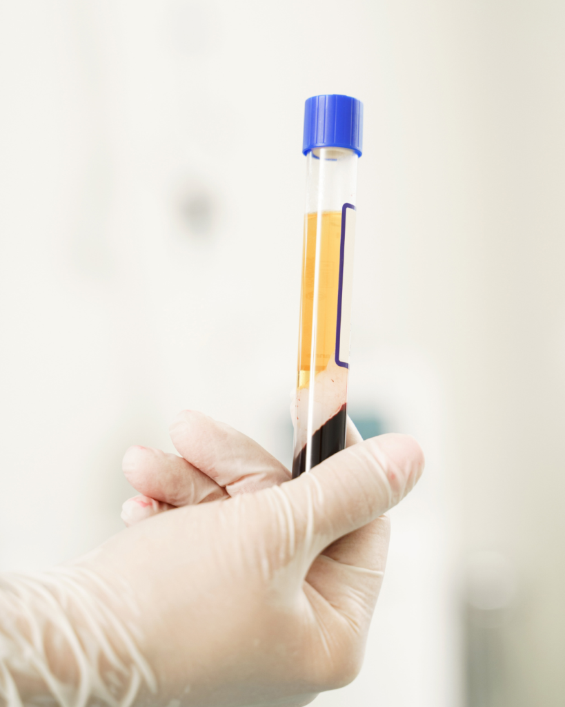 Tratamiento facial con plasma rico en plaquetas aplicado en clínica, mostrando piel rejuvenecida y luminosa.