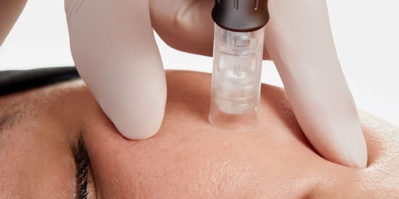 Tratamiento facial con Dermapen y mesoterapia para favorecer la absorción de vitaminas y estimular colágeno.