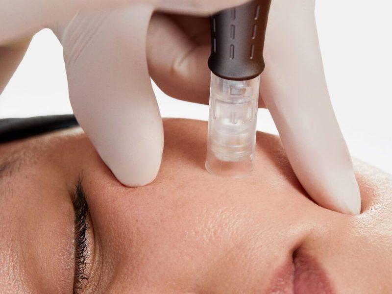Tratamiento facial con Dermapen y mesoterapia para favorecer la absorción de vitaminas y estimular colágeno.