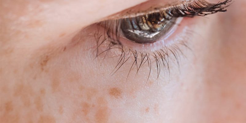 eliminar-manchas-en-la-piel