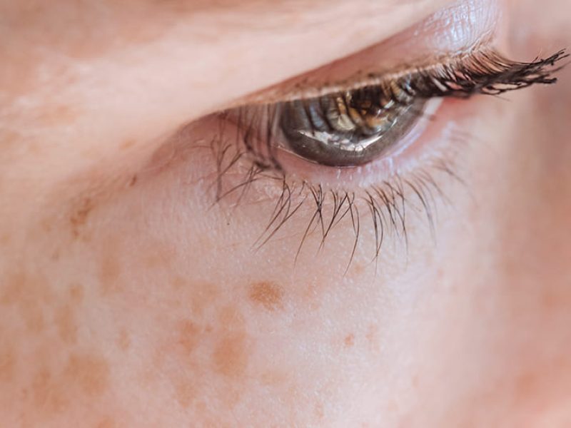 eliminar-manchas-en-la-piel