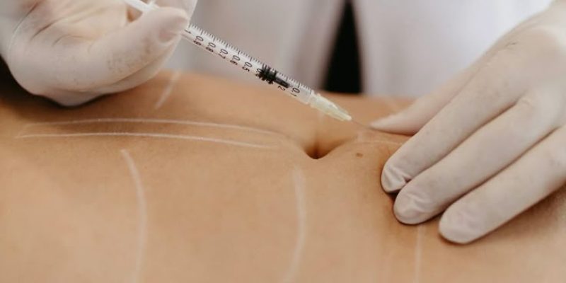 Mesoterapia reductiva y masaje en piernas para tratar grasa localizada y celulitis con protocolo Beldon.
