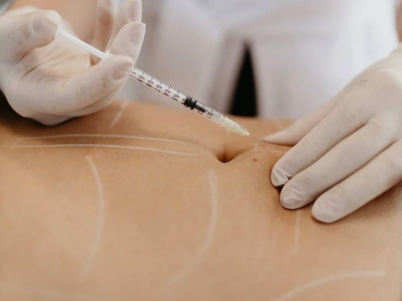 Mesoterapia reductiva y masaje en piernas para tratar grasa localizada y celulitis con protocolo Beldon.