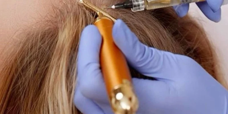 Tubo con plasma rico en plaquetas listo para su aplicación en el cuero cabelludo.