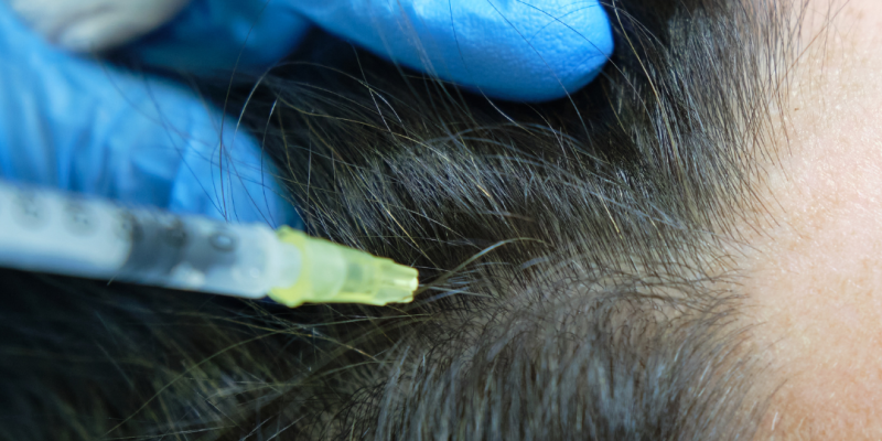 Aplicación de tratamiento capilar con plasma en el cuero cabelludo, mostrando mayor densidad y grosor del cabello.