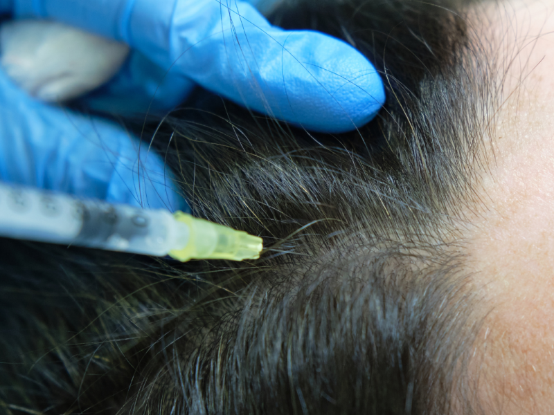 Aplicación de tratamiento capilar con plasma en el cuero cabelludo, mostrando mayor densidad y grosor del cabello.
