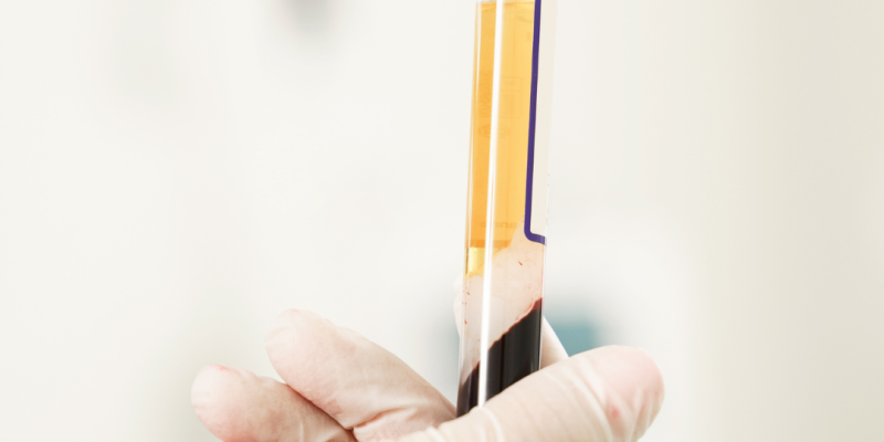 Tratamiento facial con plasma rico en plaquetas aplicado en clínica, mostrando piel rejuvenecida y luminosa.