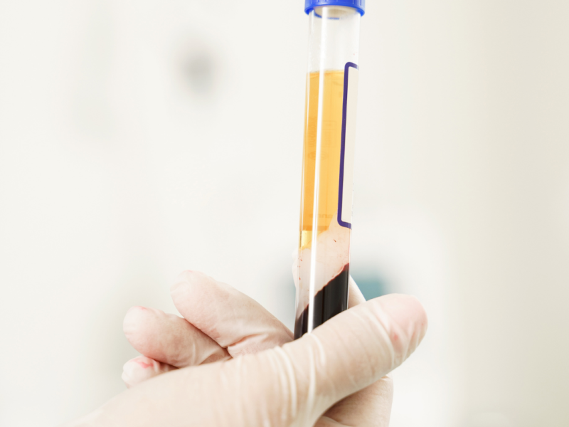 Tratamiento facial con plasma rico en plaquetas aplicado en clínica, mostrando piel rejuvenecida y luminosa.