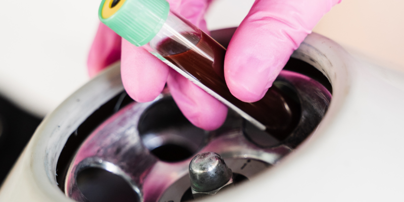 Tratamiento facial con PRP (plasma rico en plaquetas) aplicado como alternativa natural a la toxina botulínica, mostrando piel rejuvenecida.