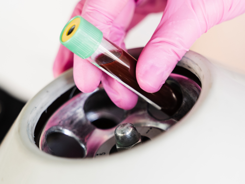 Tratamiento facial con PRP (plasma rico en plaquetas) aplicado como alternativa natural a la toxina botulínica, mostrando piel rejuvenecida.