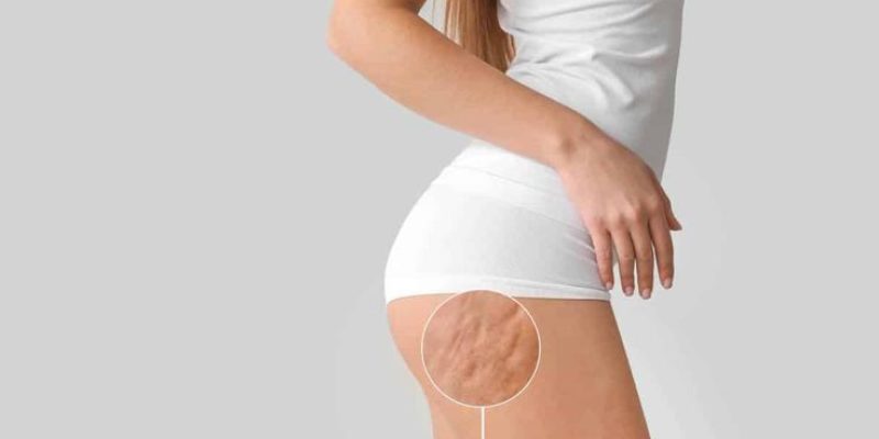 Piernas y glúteos de una persona recibiendo un tratamiento anticelulítico avanzado, mostrando mejora de la piel y silueta.