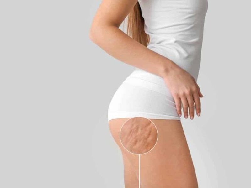 Piernas y glúteos de una persona recibiendo un tratamiento anticelulítico avanzado, mostrando mejora de la piel y silueta.